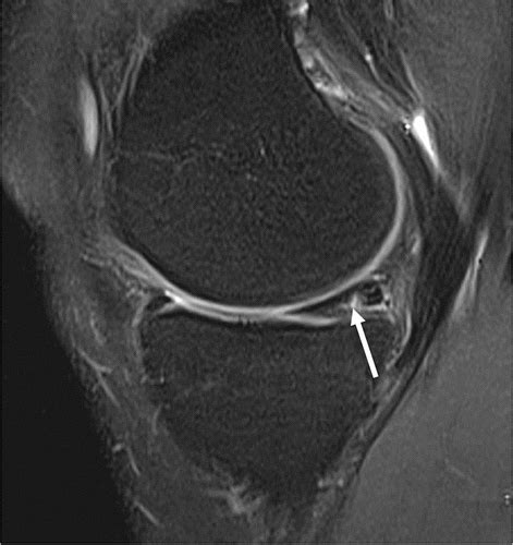 Mri T2 Mapping Of The Knee Providing Synthetic Morphologic Images