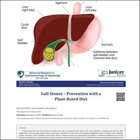 Gallstones Prevention With A Plant Based Diet Plant Based Diets In