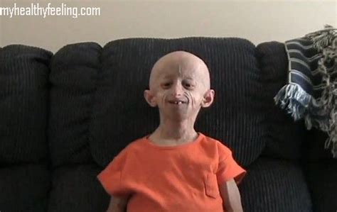 Progeria Pictures Progeria Facts Disease Symptoms Treatment