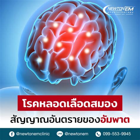 โรคหลอดเลือดสมอง สัญญาณอันตรายของอัมพาต Newton Em Clinic