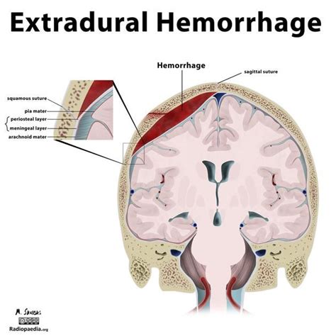 Diagram Intracranial Haemorrhage Radiology Case