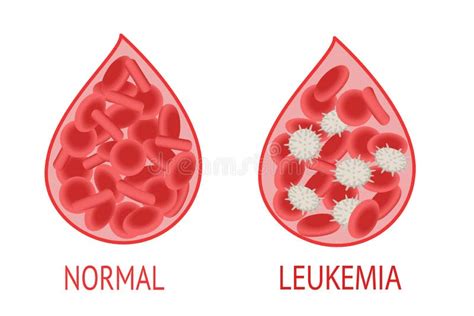Leucemia Comparação De Uma Gota De Sangue Com Células Sanguíneas