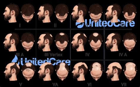 Male Pattern Baldness Identification Causestreatment And Patterns