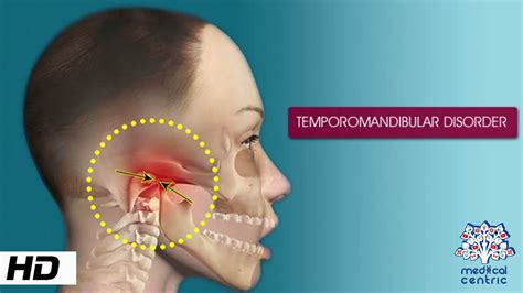 Temporomandibular Disorder Causes Signs And Symptoms Diagnosis And