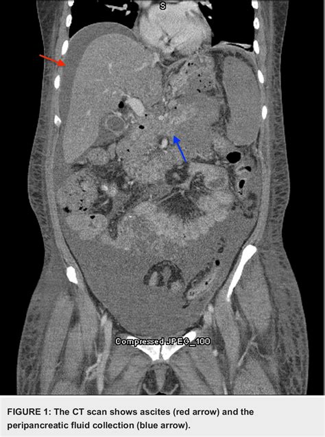 Figure 1 From A Rare Case Of Spontaneous Fungal Peritonitis Caused By