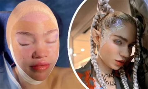 Grimes Shares A Snap Of Her Bandaged Face After Revealing She Wants To