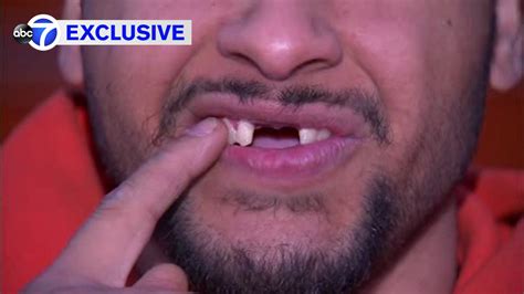 Exclusive Man Speaks Out After E Cigarette Explodes In Mouth In