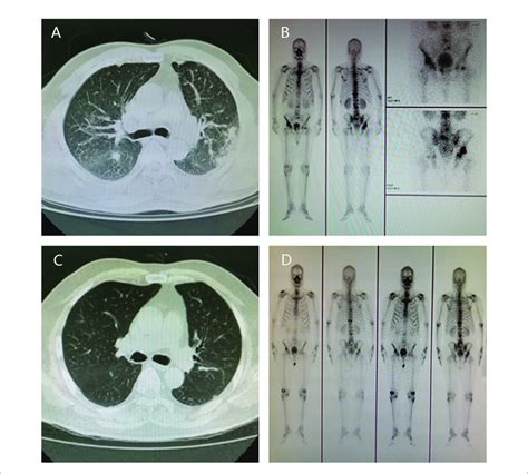 Radiographic Change Pre And Post Therapy The Results Of Ct Scan