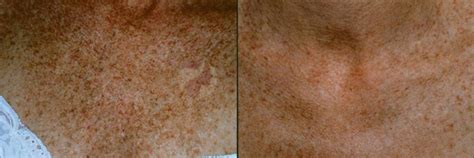 Ipl Photofacial Before And After Pictures Case 37 Dallas Tx Dallas