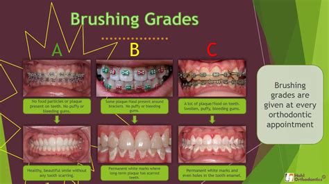 How To Floss With Braces And Swollen Gums 4 Facts To Stop You Being