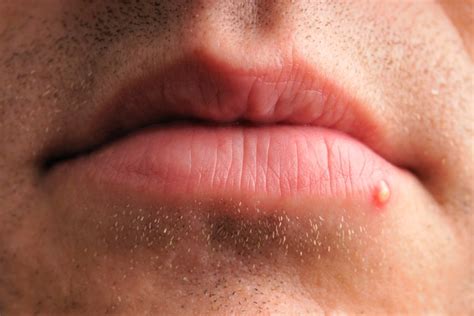 Come Identificare Un Herpes Cold Sore Vs Pimple Consigli Degli