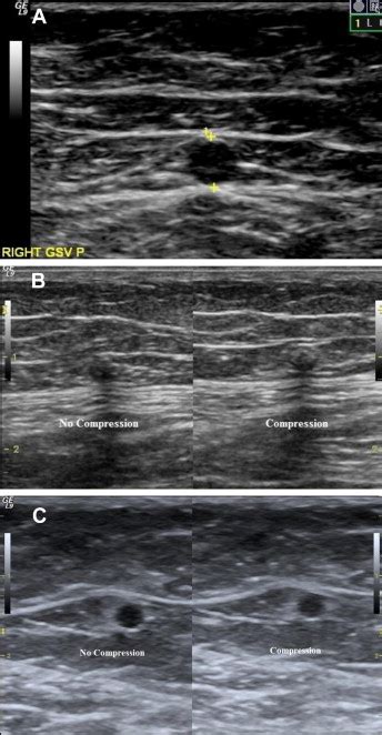 Ultrasound Images Of Incompetent Great Saphenous Vein Gsv A Before