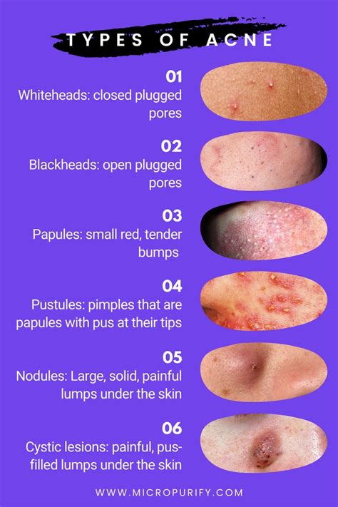 Acne Prone Skin Care Oily Skin Acne Tips For Oily Skin Moisturizer