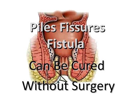 Piles Fissures Fistula Surgeon In Pune Dr Nitin Pawar Laparoscopic