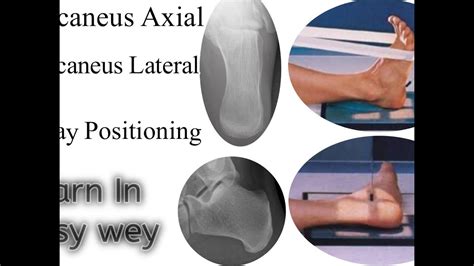 Calcaneus Axial And Lateral Positioning Calcaneus Axial View Learn In