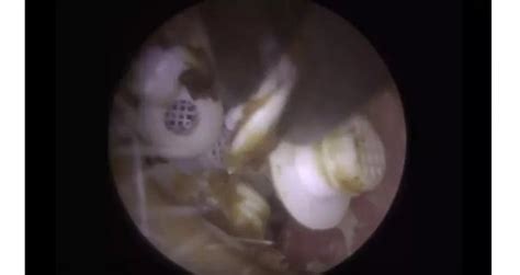 We did not find results for: Terdapat 22 Benda Asing di Dalam Telinga Pria Ini