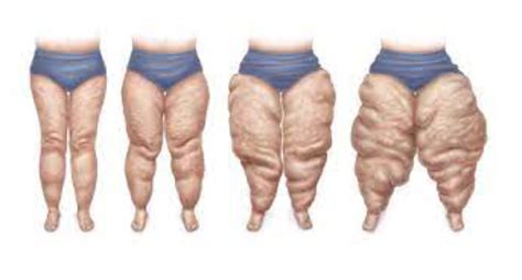 Lipo Lymphedema Stages Treatments Therapy Explained