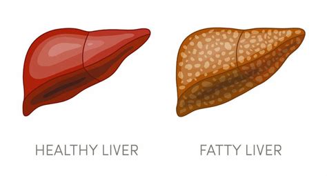 fatty liver causes types symptoms diagnosis and treatment