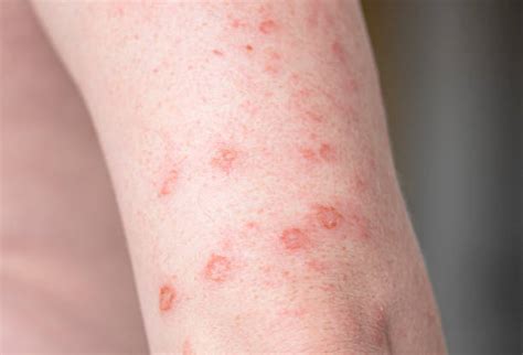 10 Syphilis Rash Stock Photos Pictures And Royalty Free Images Istock