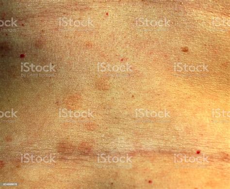 Red Flat Lichen Planus Red Spots On The Skin Of The Abdomen Stock Photo