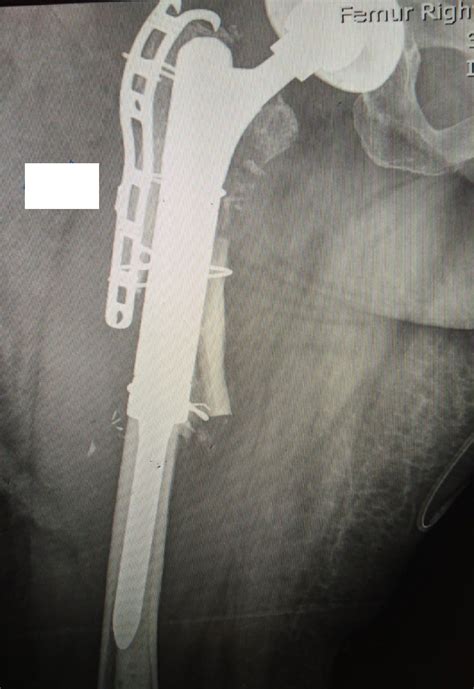 Cureus Intriguing Periprosthetic Fracture Of Hip Stem And Proximal