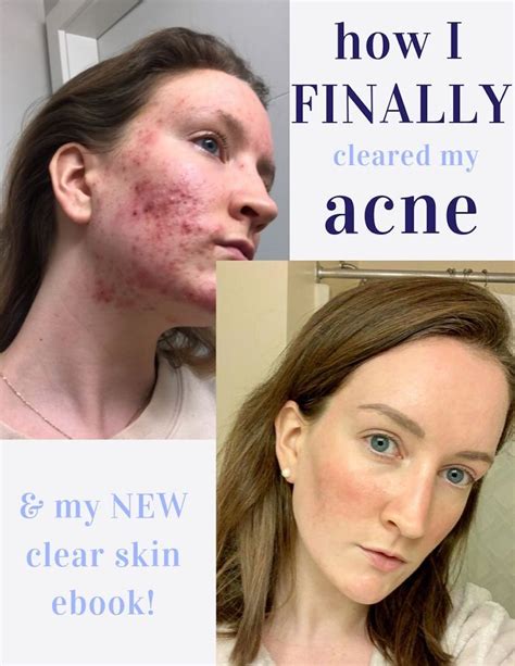How I Finally Cleared My Acne And Exciting Announcement Acne Clear