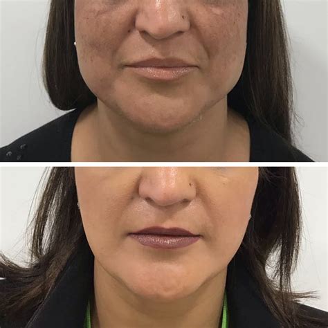 Wide Jaw Slimming With Botox Dr Aesthetica