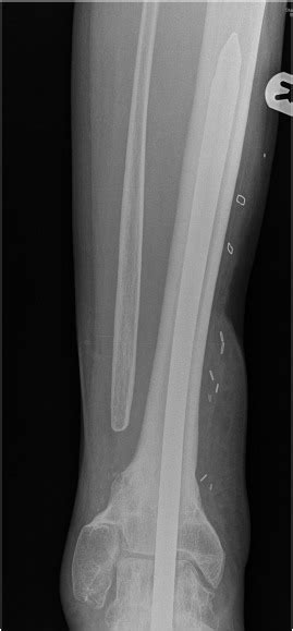 United Distal Tibial Fracture Within 6months Of The Operation