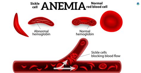 Anemia Final Sickel Cell Mr Imhotep