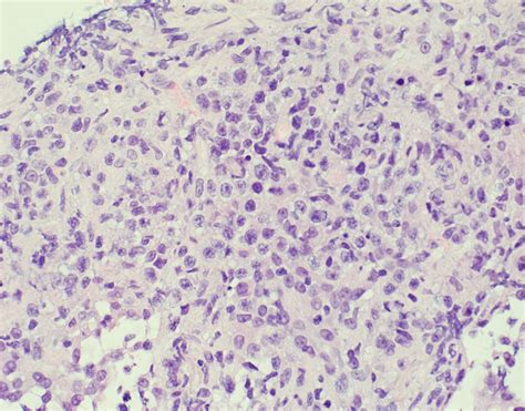 Pathology Outlines High Grade B Cell Lymphoma Nos