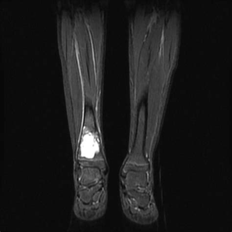 Aneurysmal Bone Cyst Tibia Radiology Case Bone