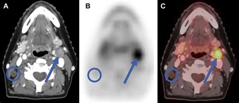 Petcomputed Tomography In Head And Neck Cancer Magnetic Resonance