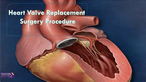 Ppt Heart Valve Replacement Surgery Procedure Powerpoint Presentation