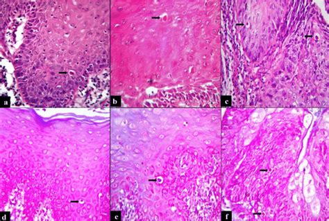 Apoptotic Cells In Different Histological Grades Of Leukoplakia A