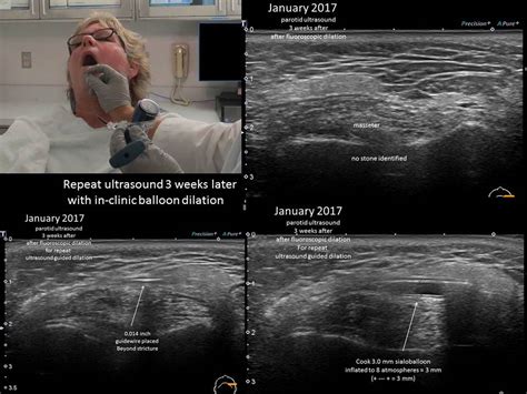 Parotid Gland On Ultrasound