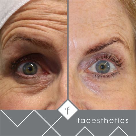 Anti Wrinkle Injections Facesthetics