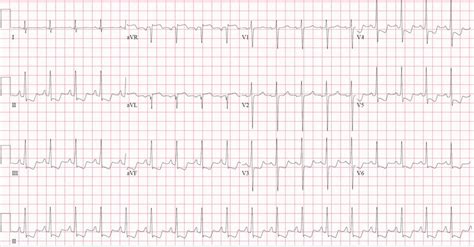 Initial 12 Lead Electrocardiogram Showing Sinus Tachycardia Diffuse