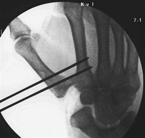 Treatment Of Advanced Carpometacarpal Joint Disease Trapeziectomy And