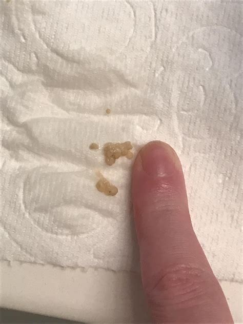 These Tonsil Stones Have Been Bothering Me For Days Finally Popped