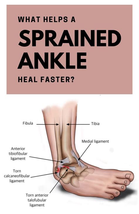What Helps A Sprained Ankle Heal Faster Sprained Ankle Sprained