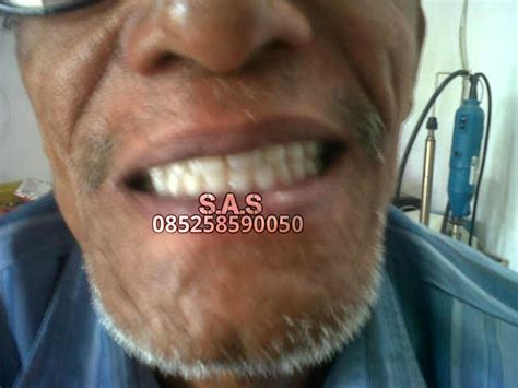 Check spelling or type a new query. Pasang Gigi Palsu Lengkap Atas Bawah / Ompong Versi Tukang ...