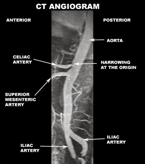 Radiology Anatomy Images Cta Abdominal Anatomy