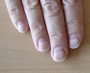 If you notice that your fingernails start to develop vertical otherwise known as. Muehrcke Lines of the Fingernails: Background ...