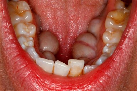 Some of the general symptoms of cancer in cats are: What are mandibular tori? | News | Dentagama