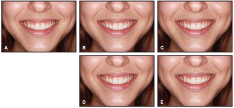 Effect Of Variations In Upper Lateral Incisors On Attractiveness