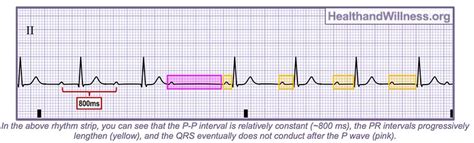 How To Read An EKG Rhythm Strip Health And Willness