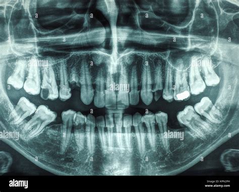 Human Teeth Xray Stock Photo Alamy