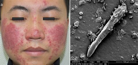 Human Skin Parasites Face