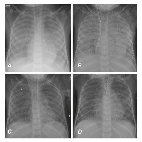 A Chest X Ray On Admission B Chest X Ray After Ecmo Cannulation