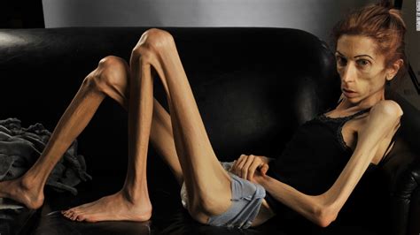 VÍdeos La Increíble Recuperación De La Mujer Con Anorexia